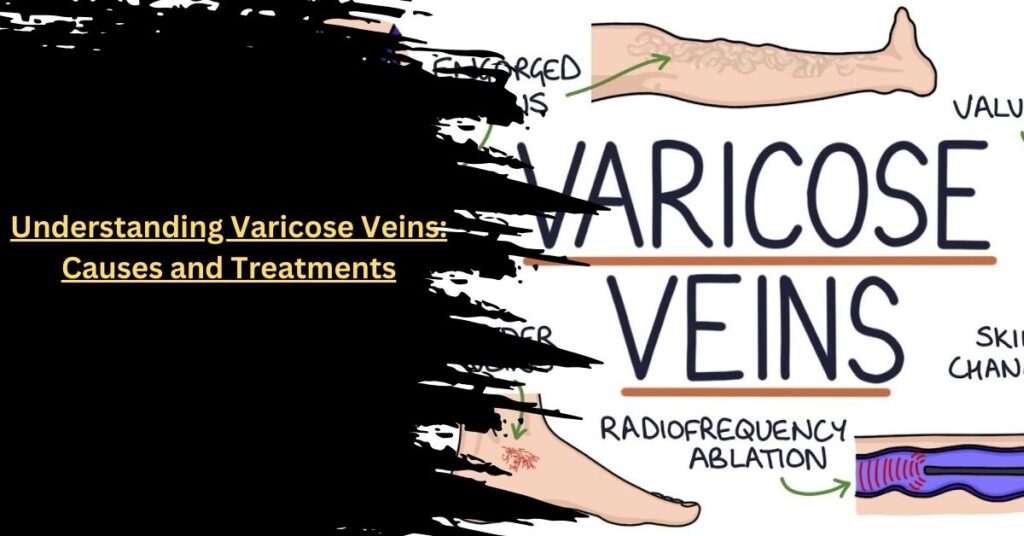 Understanding Varicose Veins Causes and Treatments