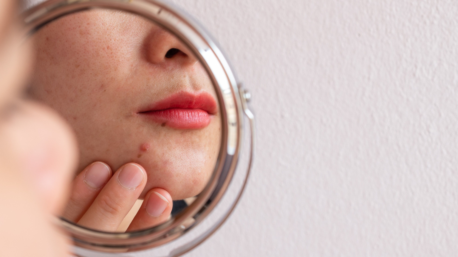 Unmasking Acne: Common Causes and Contributing Factors