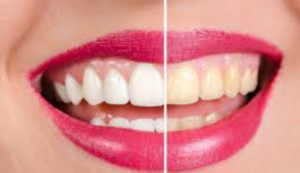 Glow Up Your Grin with Simple Strategies for a Dazzling Smile